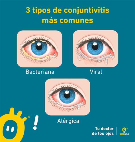 Etapas Iniciales De La Conjuntivitis Secretaría Conjuntivitis O