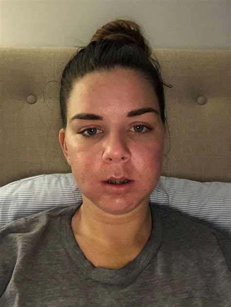 Underbite Surgery Swelling