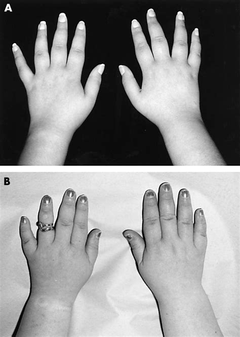 Coffin Lowry Syndrome Hands