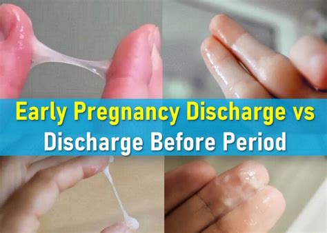 Discharge Before Period vs. Early Pregnancy: Key Differences