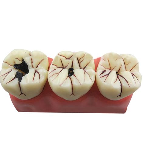 Buy Nicekko Teeth Dental Caries Evolution Model Doctor-Patient ...