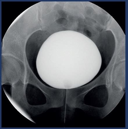 Image result for Videocystometrogram Procedure