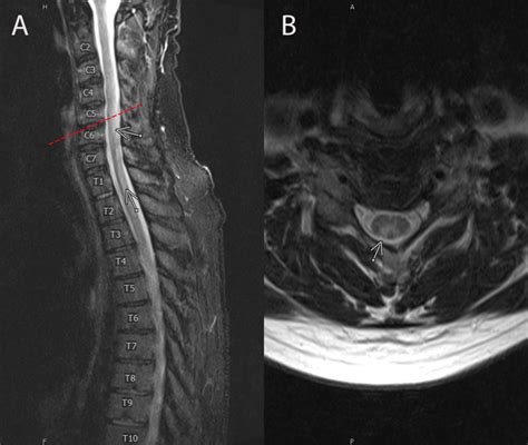 Subacute combined degeneration of the spinal cord in a patient with ...