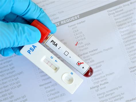 Psa level in prostatitis. PSA Levels in Prostatitis: Understanding Elevated PSA and Treatment ...