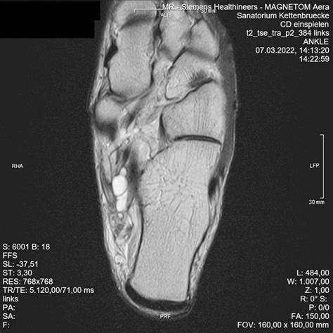 Das Tarsaltunnelsyndrom – eine diagnostische und therapeutische Heraus ...
