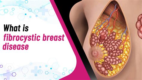 What is Fibrocystic Breast Disease? | Causes, Symptoms, Diagnosis ...
