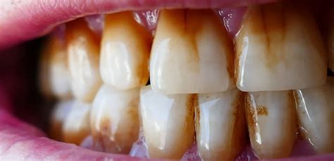 Image result for Tooth Stain