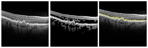 Interleaving Automatic Segmentation and Expert Opinion for Retinal ...