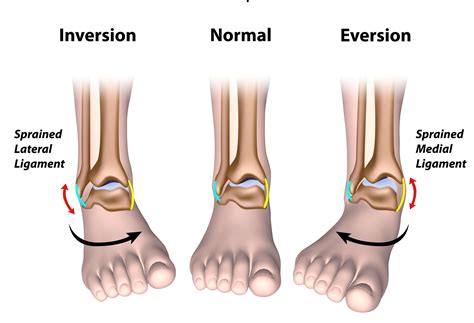 Sprained Ankle - Runner's Guide to Diagnosis, Treatment & Prevention