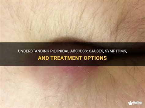 Understanding Pilonidal Abscess: Causes, Symptoms, And Treatment ...