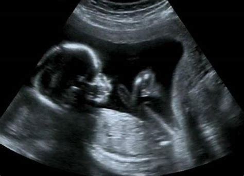 25周胎儿大小（分析怀孕25周宝宝是什么样子的） - 主妇去哪儿