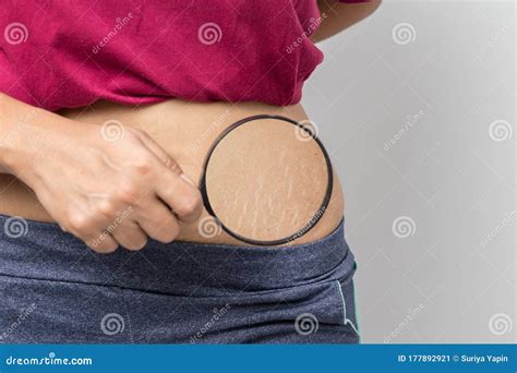Women Show Off the Belly after Birth. Stretch Marks on White Background ...