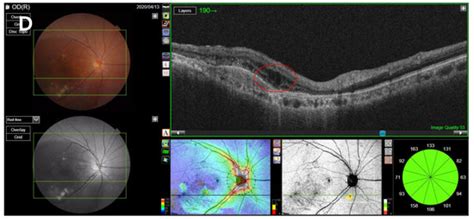 Impact of Delayed Intravitreal Anti-Vascular Endothelial Growth Factor ...