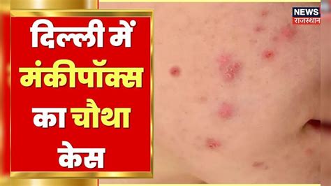 Monkeypox in India | Delhi में मंकीपोक्स का चौथा केस, 31 साल की ...