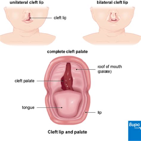 Cleft Lip And Palate Diagram