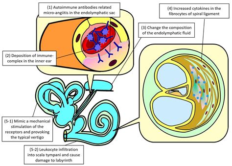 Audiovestibular Dysfunction in Patients with Hashimoto’s Disease: A ...
