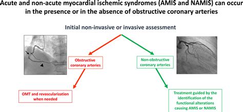 Myocardial Ischemic Syndromes: A New Nomenclature to Harmonize Evolving International Clinical ...