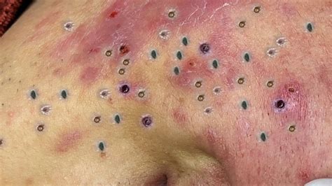 Image result for Exploding Zit Videos 2013