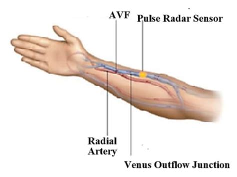 Arteriovenous Fistula Flow Dysfunction Surveillance: Early Detection ...