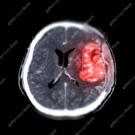 CT scan of the brain axial view post operative brain tumor. 이미지 (1349428291) - 게티이미지뱅크