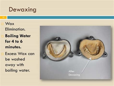 Image result for Partial Denture Procedure