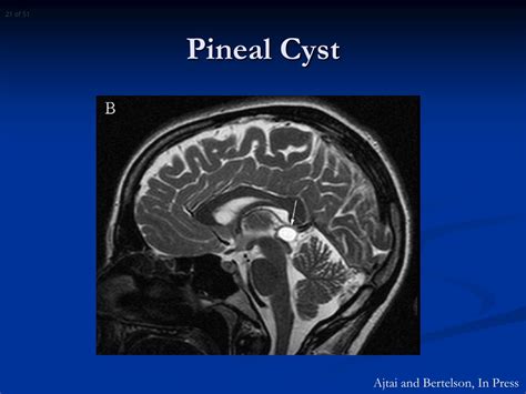 PPT - Intracranial Cysts: Diagnosis and Management Overview PowerPoint Presentation - ID:9116156
