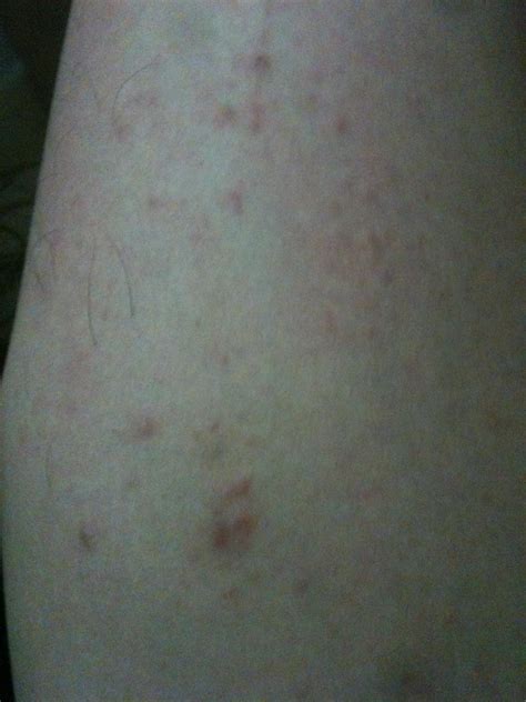 大腿小腿长了好多痘痘，像湿疹一样，这个病是去年就会的，一到冬天就会没有！_百度知道