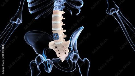 Image result for Spinal Fixation