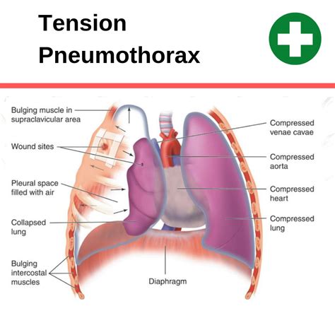 difference between pneumothorax and atelectasis - Captions Watch