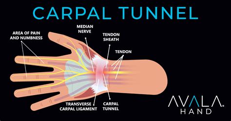 Carpal Tunnel Syndrome - AVALA