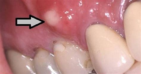Image result for Abscessed Tooth Explosion