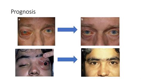 Carotid Cavernous Fistulas | PPTX