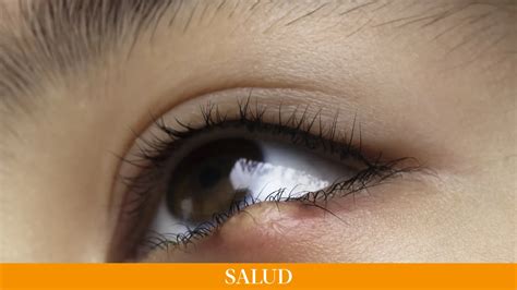 Qué son los orzuelos y por qué salen