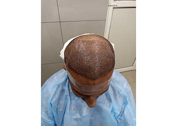 3 Best Hair Transplant Surgeons in Srinagar - Expert Recommendations