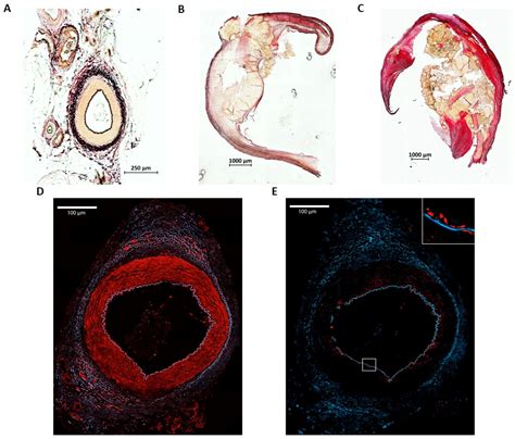 Influence of Atherosclerosis-Associated Risk Factors on Expression of ...