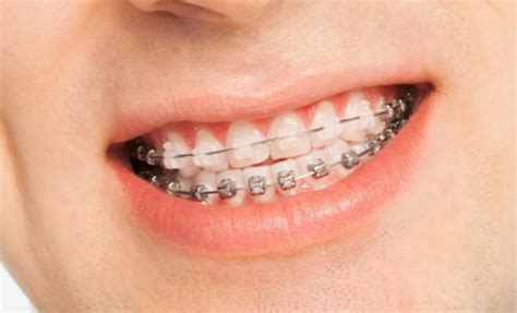 How much does Braces Cost