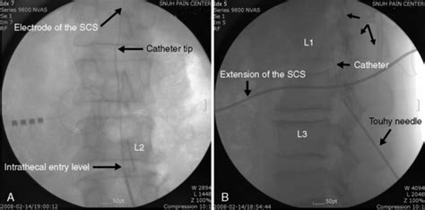 Image result for Selective Nerve Root Block vs Transforaminal
