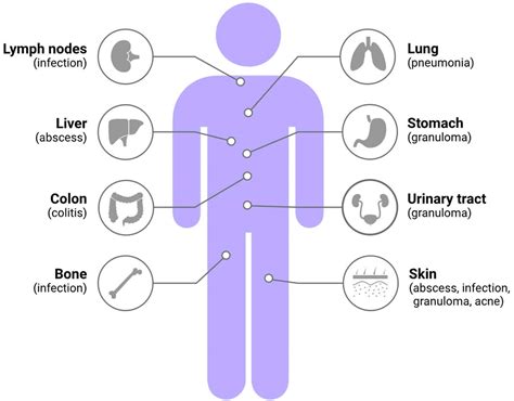 Chronic granulomatous disease causes, symptoms, diagnosis & treatment