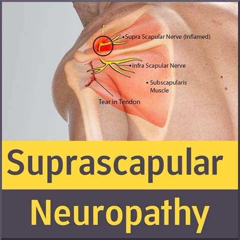Suprascapular Nerve