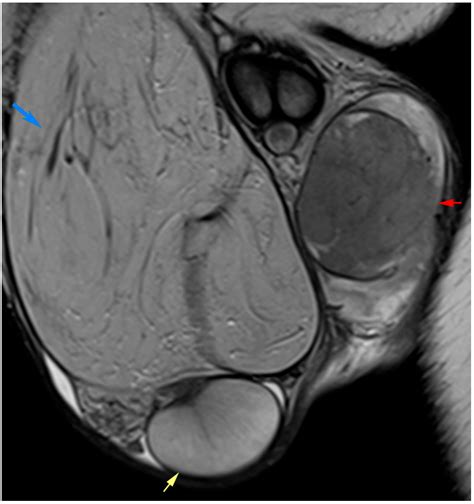 MRI of the Scrotum and Penis: Current Applications and Clinical Relevance