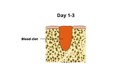 Image result for Tooth Extraction Day 2