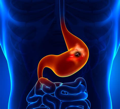 Stomach Ulcer | Peptic Ulcer | MedlinePlus