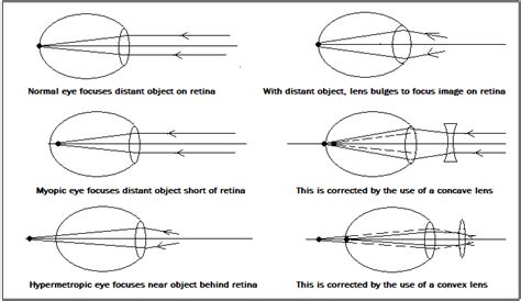 Spectacles that change, like the lens of the eyes, is the next step in ...