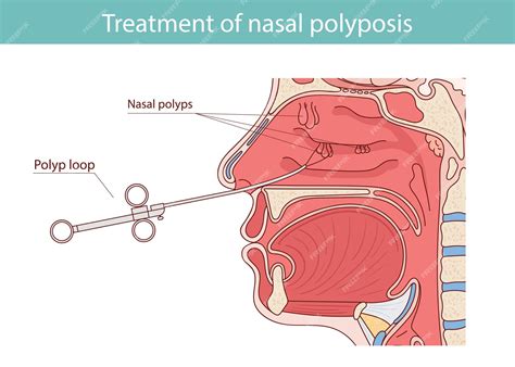 Premium Vector | Nasal Polyps Diagram Anatomy of the nasal cavity ...