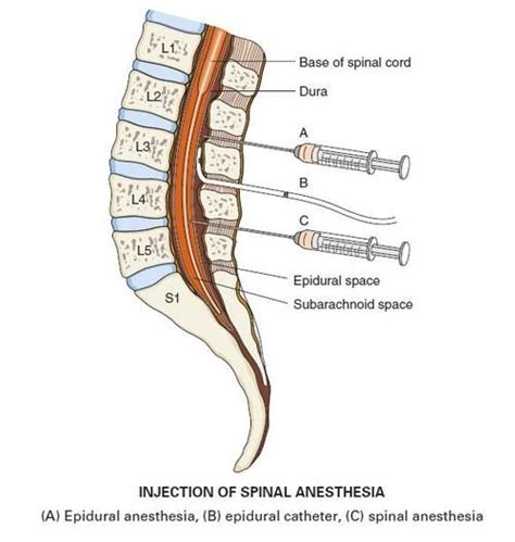 Image result for Spinal Injection Coding Videos