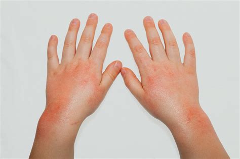 10 Effective Home Remedies For Scabies