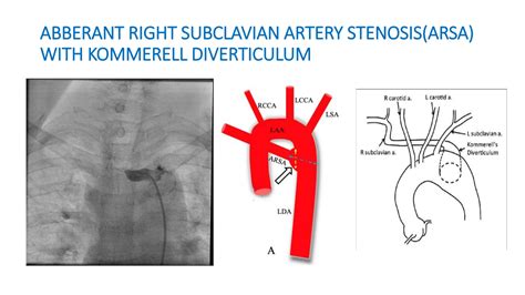 STENOSIS OF ABBERANT RIGHT SUBCLAVIAN ARTERY WITH KOMMERELL ...