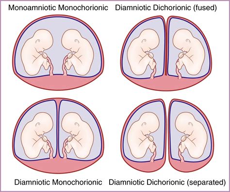 Multiple Gestation: The Biology of Twinning - Clinical Tree