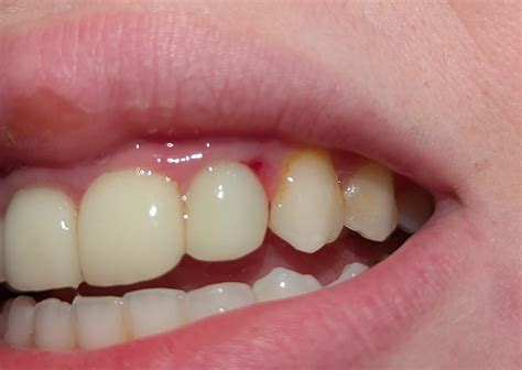 Swollen/bleeding gum around new(ish) crown : r/Teethcare