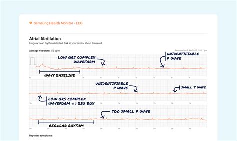 What Is a Normal ECG Reading? Essential Guide | Qaly